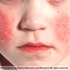 Infectious Mononucleosis Chronic 