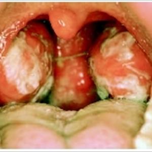 Mononucleosis Information