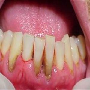  Infectious Mononucleosis