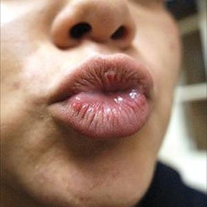  Mononucleosis: The Kissing Disease